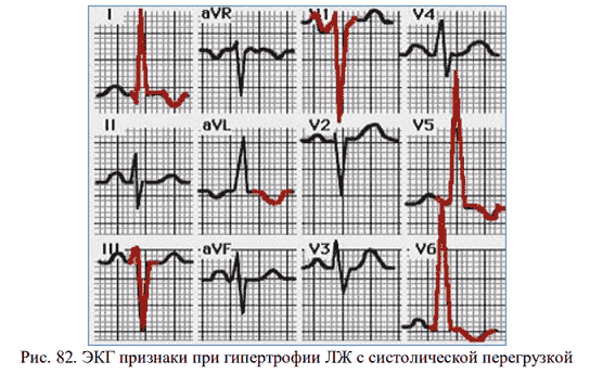 Гипертрофия левого желудочка