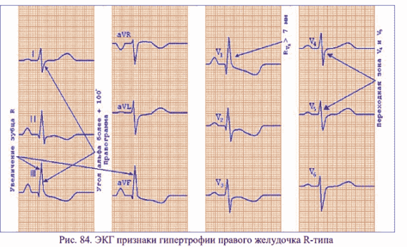 Гипертрофия правого желудочка