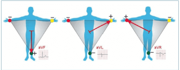 Три усиленные Электрокардиографических отведения по Гольдбергу