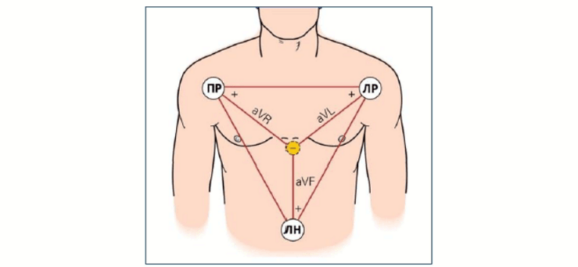 Усиленные отведения от конечностей в виде треугольника Эйнтховена