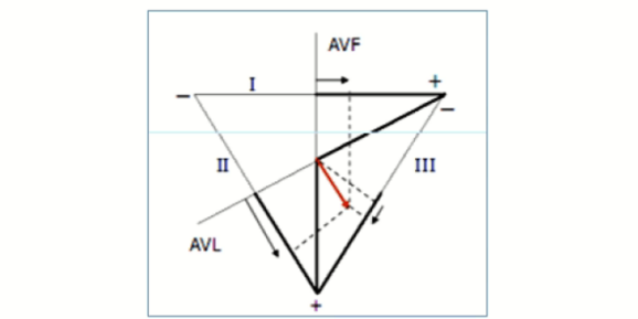 Стандартные и усиленные однополюсные отведения от конечностей в треугольник Эйнтховена