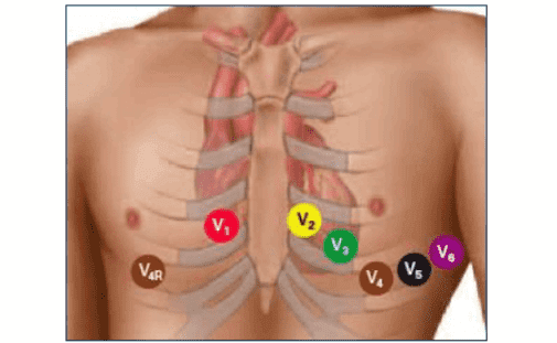 Места наложения шести грудных электродов