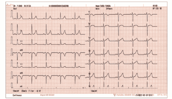 Система 12 электрокардиографических отведений нормальной ЭКГ