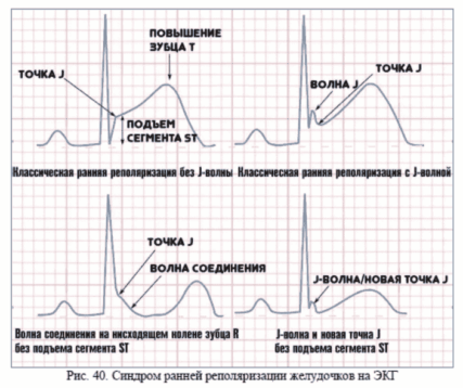 Синдром ранней реполяризации желудочков