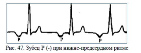 Предсердный ритм