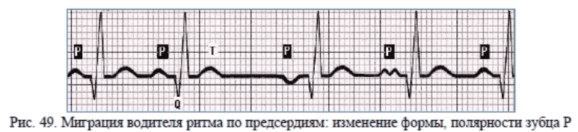 Миграция суправентрикулярного ритма и желудочковый ритм