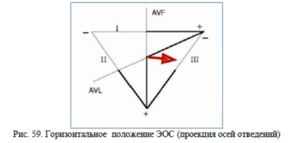 Горизонтальное положение электрической оси сердца