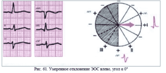 Горизонтальное положение электрической оси сердца