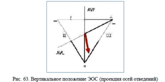 Вертикальное положение электрической оси сердца