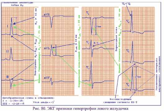 Гипертрофия левого желудочка